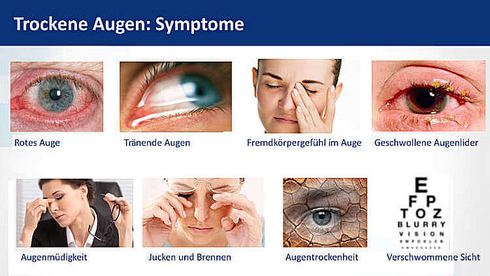 Trockene Augen Symptome